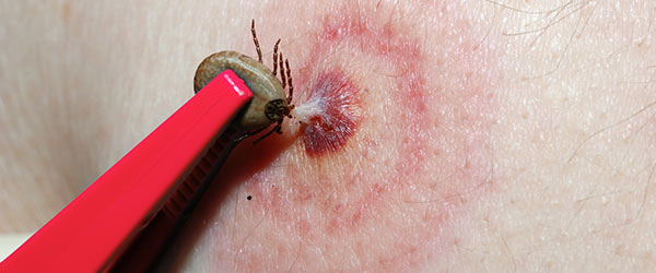 Bullseye-rash-tick-bite-lyme-disease